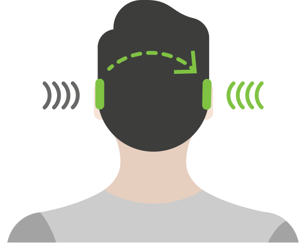 CROS system for single-sided deafness (SSD)