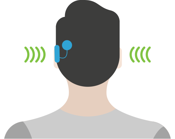 Cochlear implant system for single-sided deafness (SSD)