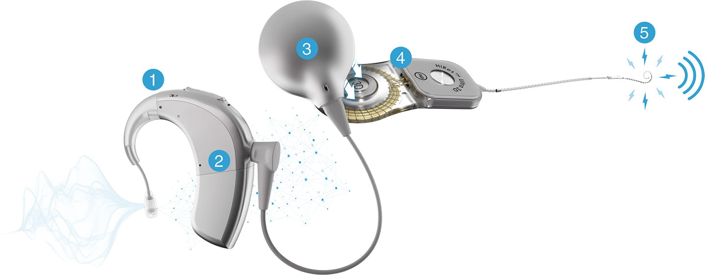 Diagram showing how a cochlear implant works, featuring Naída CI Integro