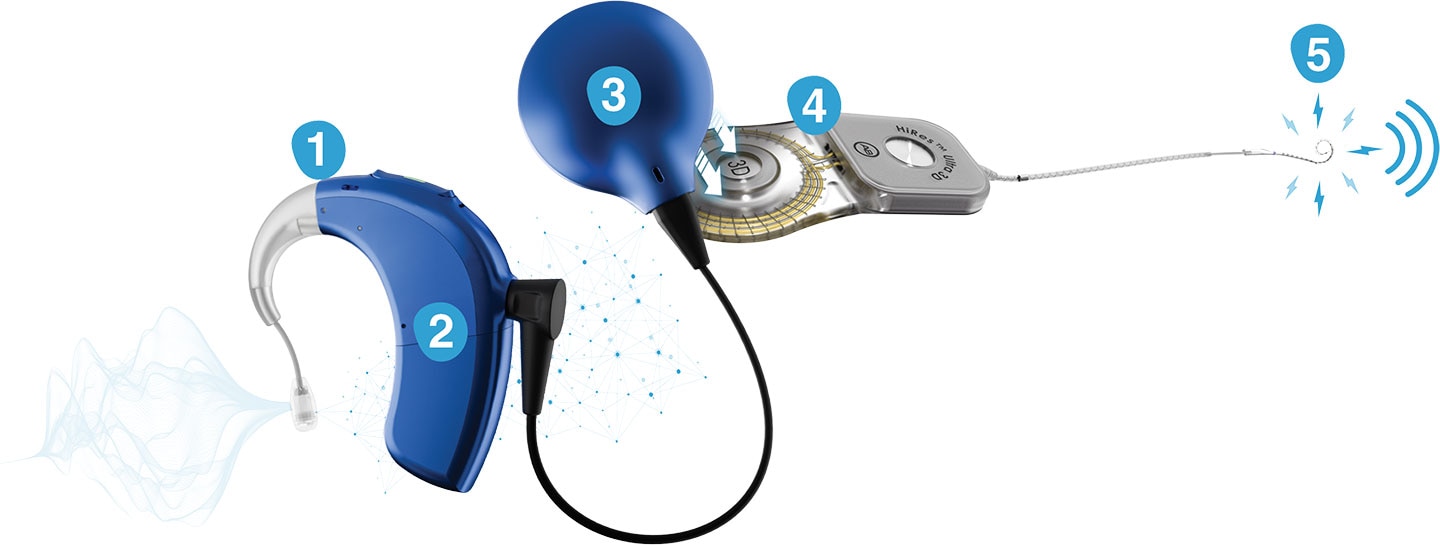Diagram showing how a cochlear implant works, featuring Sky CI Integro