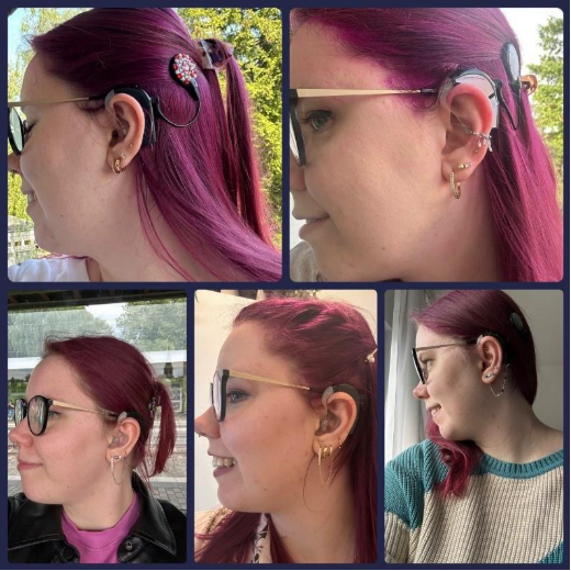 Luisa showing her cochlear implant on her head, sharing her experience after choosing a cochlear implant.