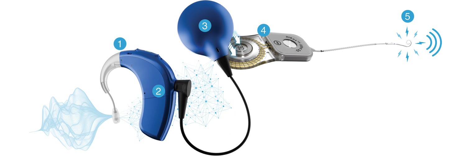 Diagram showing how a cochlear implant works, featuring Sky CI Integro
