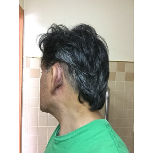 A man showing his healed surgery spot after getting a AB cochlear device implanted