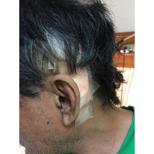 A man showing his bandaged surgery spot after getting a AB cochlear device implanted
