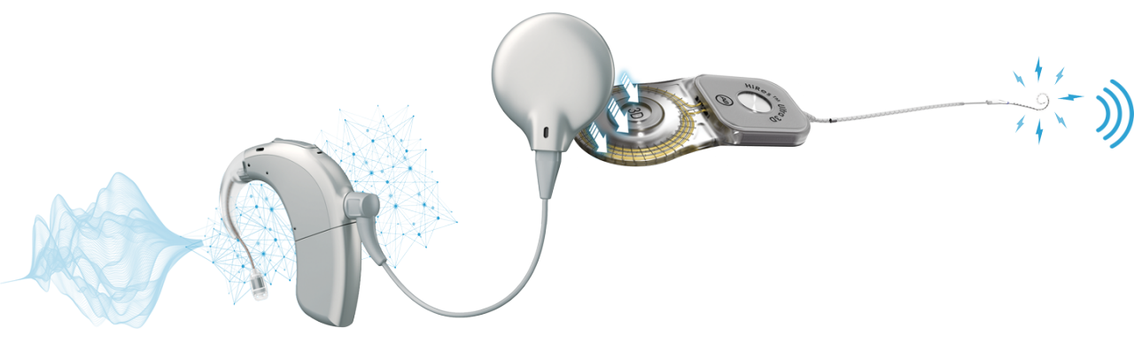 How to Determine the Cost of a Cochlear Implant for You - Wyatt ...