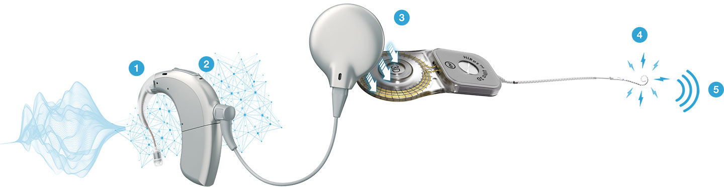 A numbered diagram showing how the Naída CI Marvel cochlear implant sound processor works