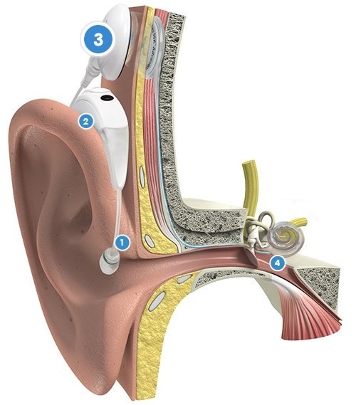 De werking van een cochleair implantaat (CI) met Naída CI Q90 spraakprocessor met T-Mic 2 microfoon met zendspoel (UHP) in de kleur Alpine White en het HiResTM 90K Advantage implantaat