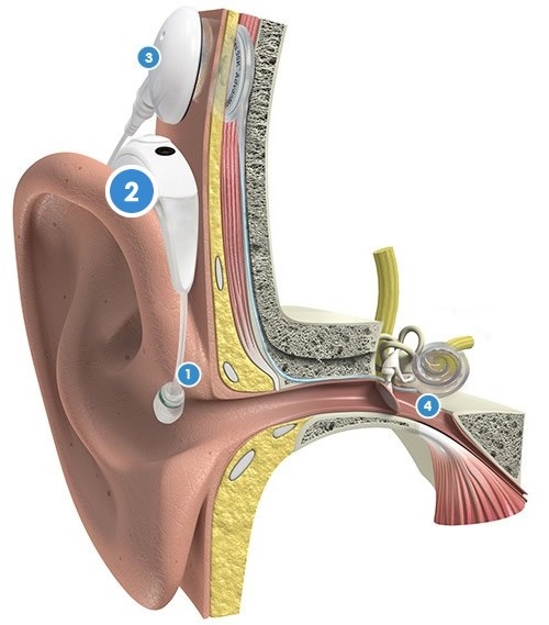 De werking van een cochleair implantaat (CI) met Naída CI Q90 spraakprocessor met T-MicTM 2 microfoon met zendspoel (UHP) in de kleur Alpine White en het HiResTM 90K Advantage implantaat
